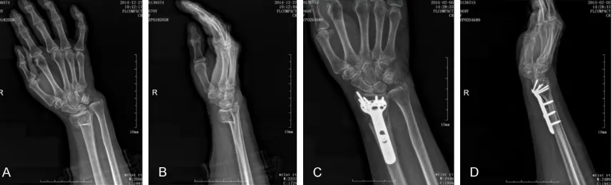 Table 4. Preoperative and postoperative radiological measurements 