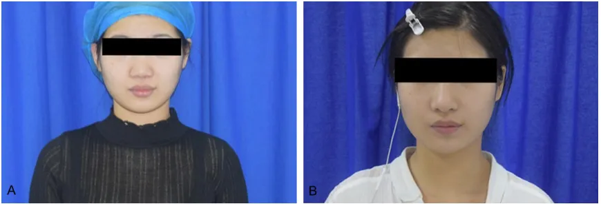 Figure 3. Typical case example. A: Full face before surgery; B: One month after the surgery.