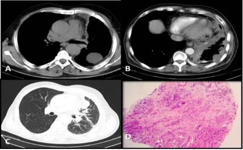 Figure 1a, b, c, d, and e: Left apical mass with ipsilateral pleural effusion and multiple bone metastases (a, b, c), Chest X-ray demon-strates left hilar enlargement and left pleural effusion (d), Regression of pathological findings illustrated on chest X-ray after 4 cycles of cisplatin-gemcitabine (e) 