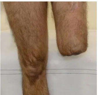 Fig. 1.A through-knee amputation. 