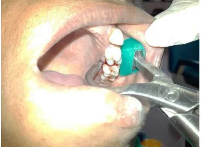 Fig 3 Extraction of Maxillary Molar (Left) using Physics Forceps   