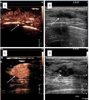 Figure 1. Two-dimensional ultrasonograph and CEUS of malignant and benign breast tumors