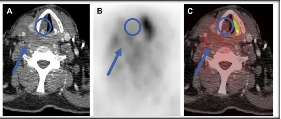 Fig. 7 False-negative CT overlooks nodal disease. (A) On axial unenhanced CT, the 4-mm lymph node (arrow) is too small to be suspicious by size criteria alone