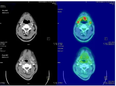 Fig: 9 - 65/M with Carcinoma tongue, T4N2M0 with pre-RT PET showing bilateral level 2a with highest SUV of 7.85 and post RT PET after 12 weeks showing no nodal recurrence – DS 1  