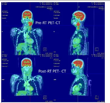 Fig: 10 - 50/M with Carcinoma left oropharynx, T1N2bM0 with pre-RT  PET showing left level 2, 3 nodes with highest SUV of 9.12 and post- RT PET after 12 weeks showing significant regression   