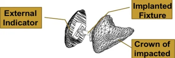 Figure 1. 3D digital image of jaws (A) and impacted teeth (B) by 3D recon-struction.