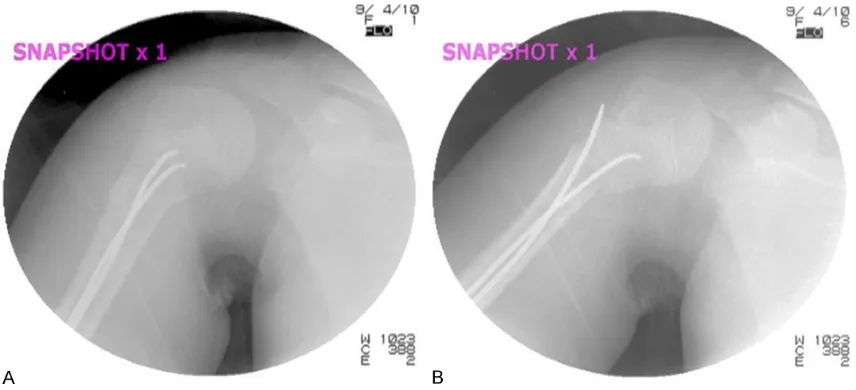 Figure 5. Snapshots of intraoperative fluoroscopy; A. On AP view, both nails appear to be inserted correctly in the proximal fragment; B
