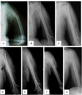 Figure 6. Proximal protrusion of lateral nail; A. Angulated shaft fracture; B, C. Proximal end of lateral nail protruded laterally on x-ray control after 7 days; D, E