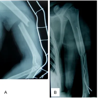 Figure 7. Deformation of nail due to difficult inser-tion; A. Displaced mid-shaft humerus fracture; B