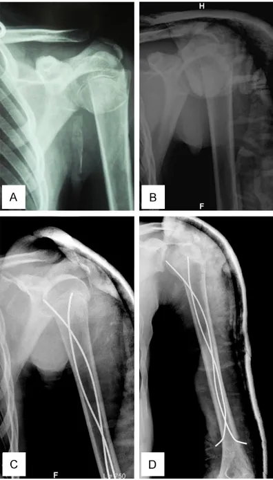 Figure 1. Lateral and medial nail insertion for retro-grade ESIN; A. Isolated displaced proximal humeral fracture (patient No