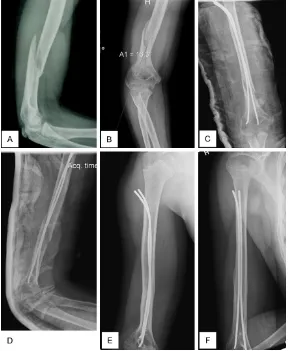 Figure 2. Retrograde ESIN with dual lateral nail insertion; A. Angulated shaft fracture in polytrauma patient (patient No