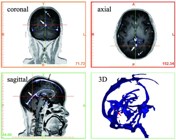 Figure 3. This figure shows the dural sinus and deep veins, surrounded by the decomposition model from various angles.
