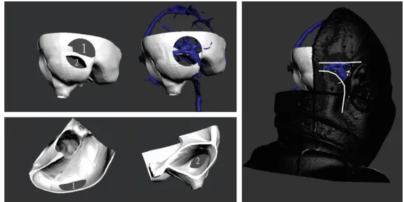 Figure 7. The consistency of dural sinus and deep vein atlas with the cor-responding parts in reference model