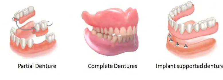 Figure 2.1: Type of denture. 