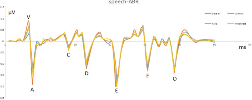 Figure 1. A typical speech ABR with 6 characteristic peaks (V, A, D, E, F, O) elicited by the speech stimulus /da/ and show the grand average waveform for the patients group (severe, blue line; moderate, yellow line; mild, gray line) and the control group 