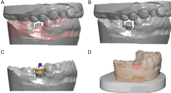 Figure 1. The model of implant-abutment.