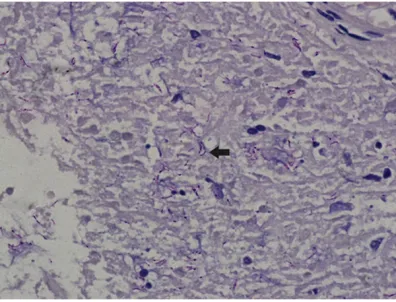 Figure 2. The granulomatous lesion in the dermis layer. (HE staining, 4×10).