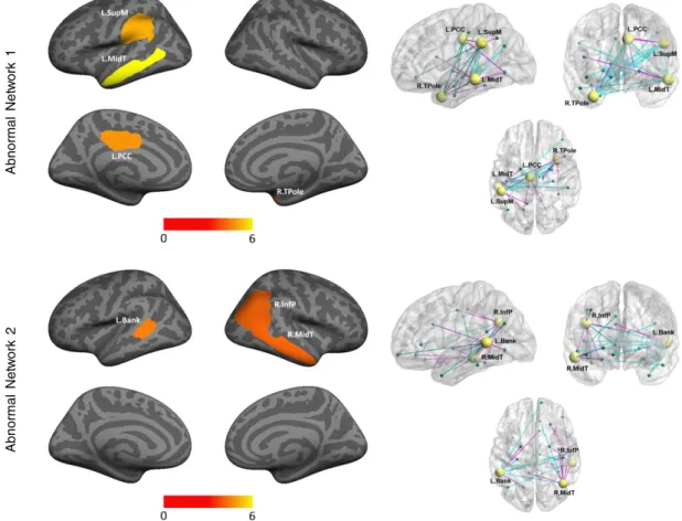 Fig. 4. Abnormal regions inferred by our Bayesian model for K = 2 using the ABIDE dataset