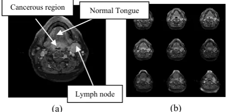 Fig. 1. (a) A T1-weighted Gadolinium-enhanced head and neck MR image example with cancerous lymph  nodes; (b) A image serires from one MRI dataset 