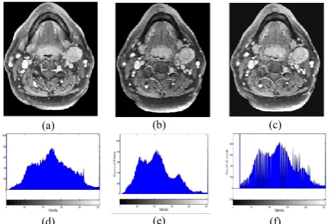 Fig.2. The throat is detected by two fuzzy rules [8]. Then Steps of tumour detection on central slice are also shown in modified fuzzy c-mean (MFCM) [14] utilises intensity and spatial information of pixels to organise them into five clusters