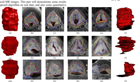 Fig. 5. Tumour segmentation using 3D level set method: (a) initial cube, (b)(c)(d) 3D evolving process, (d) segmented tumour