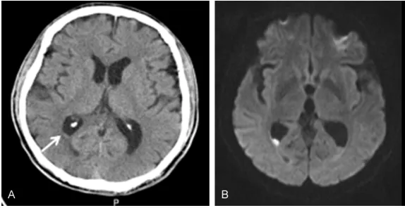 Figure 1. Plain CT and contrast-enhanced CT of lumbar vertebra before ad-mission and on day 5