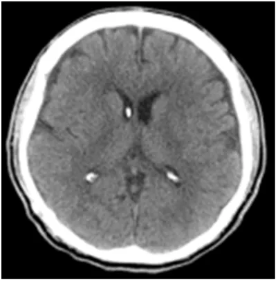 Figure 4. Brain plain CT scan performed one month after operation. Ventriculo-peritoneal shunt was plac- ed and the hydrocephalus was relieved.