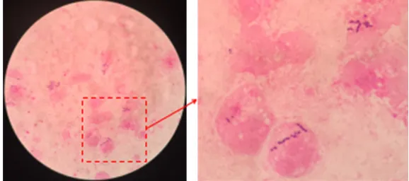 Figure 5. Light microscopy (1000 × magnification) of gram stained pus sam-ple showed gram positive cocci in chain (arrow).