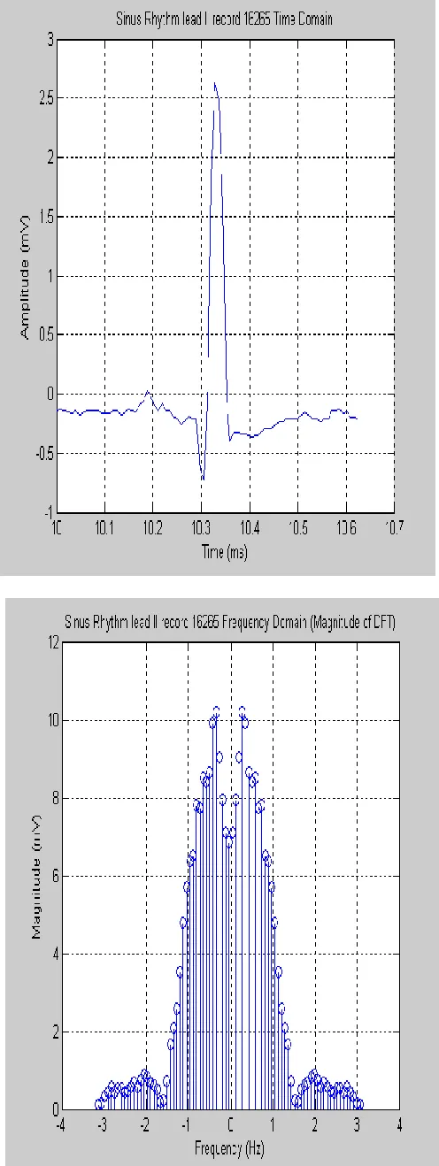 Table II  ECG parameter for Measurement itself 
