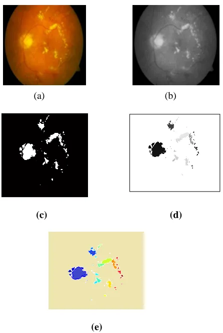 Fig. 2.  (a)   Original input image. (b)Diabetic Retinopathy labeling image.  Thresholding process after intensity conversion