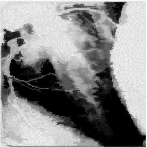 Figure 5. Enlarged gray level image for the previous heart image shows the exact the exact location of blood clots that block the supply of blood to the heart muscle, causing a heart attack after segmentation and labelig