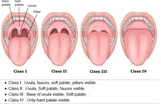 Figure showing Modified Mallampati Classification 