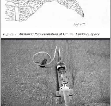Figure 2: Anatomic Representation of Caudal Epidural Space 