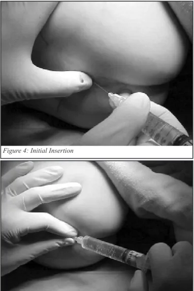 Figure 5 Repositioning and Completion of Epidural Injection 