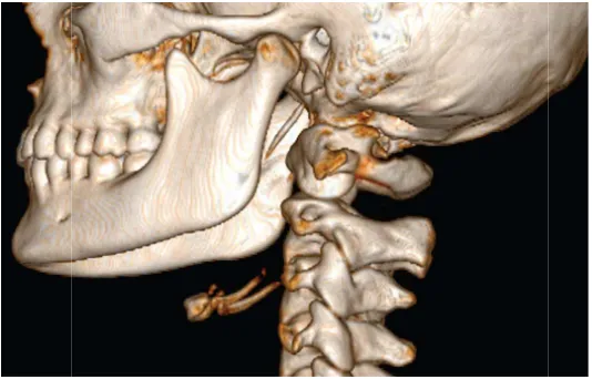 Figure: Volume Rendered CT of Neck with reconstruction showing SP Figure: Volume Rendered CT of Neck with reconstruction showing SPFigure: Volume Rendered CT of Neck with reconstruction showing SP