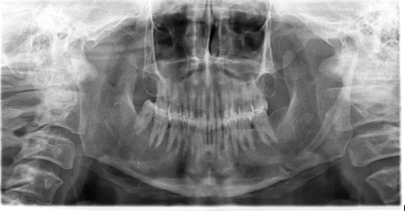 Figure: Digital OPG of Bilateral elongated Styloid process with 