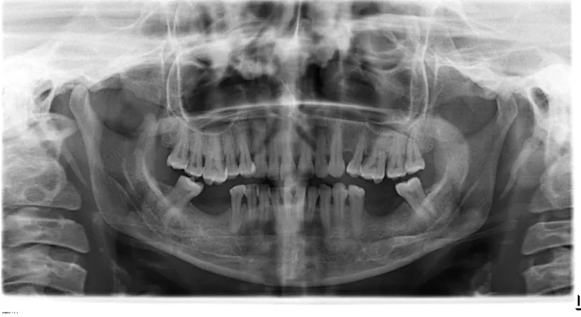 Figure: Bilateral elongated styloid process by OPG Digital 