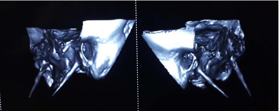 Figure: CT 3D - reconstruction of styloid process 