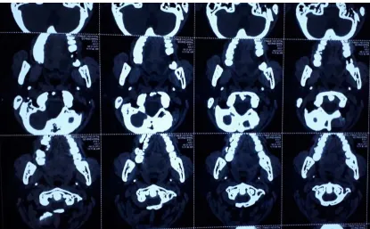 Figure: Axial cuts of Neck with temporal bone show styloid process. 