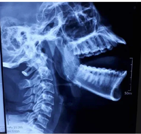 Figure: Conventional Radiograph showing elongated styloid process 