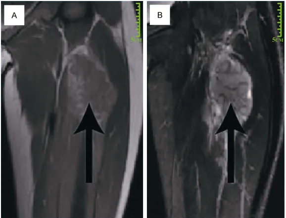 Figure 3. HE staining of pPNET (200×). The arrow in-dicates Homer-Wright type rosette forming.