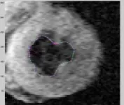 FIGURE 1:  MR Image of the left ventricle of human heart 