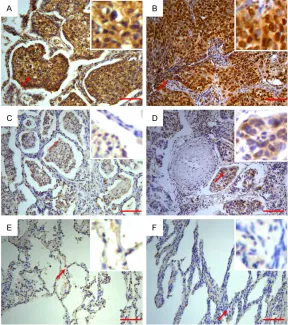 Figure 1. Expression of SUMO1 in NSCLC. A. Optical overexpression SUMO1 staining in ADC