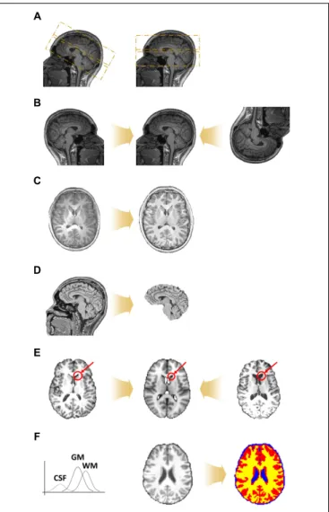 FIGURE 1 | Diagram of the preprocessing steps for volume-based (A) T1-weighted structural MRI and (B) fMRI data.