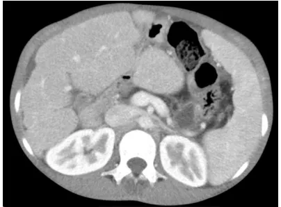 Figure 1. Chest computed tomography (CT) scan showed the severe bronchiectasis and peribronchial infiltration in both lung fields.