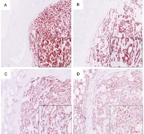 Figure 3. Immunohistochemistry findings show that the tumor cells were strongly positive for CD10 (A), CK (B), EMA (C) and vimentin (D)