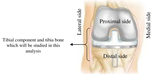 Fig. 1. (a) The details of the total knee components (b) The total knee components are inserted in a knee joint 