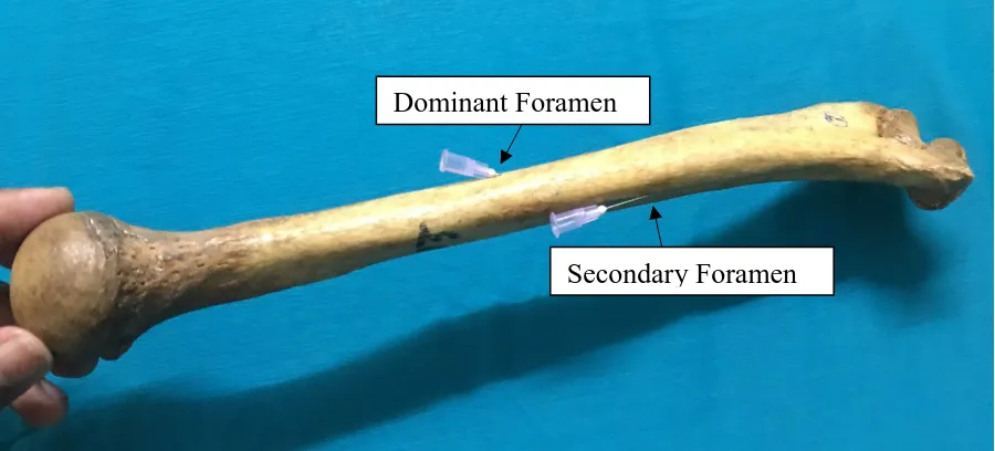 Fig. 6 – Finding the direction of nutrient foramen and obliquity of nutrient canal using a fine stiff wire