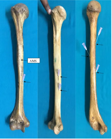 Fig. 7 – Humeri showing single, double and triple foramina. The bone with the single foramen has a dominant foramen in the anteromedial surface, in the middle third of the shaft