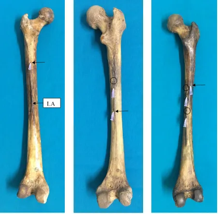 Fig. 13 – Femur showing a single secondary foramen in the linea aspera.